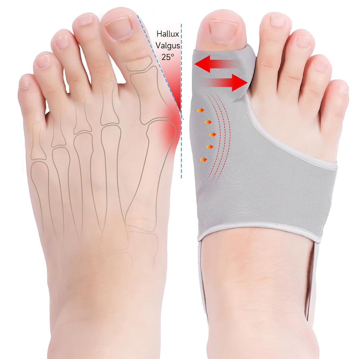HYGGEAR BIG TOE BUNION (HALLUX VALGUS) CORRECTOR